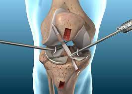 especialista en artroscopia de rodilla