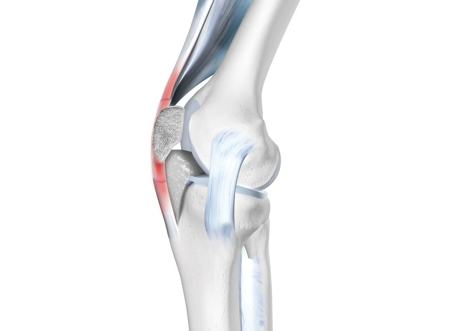 Tendinitis de Rodilla